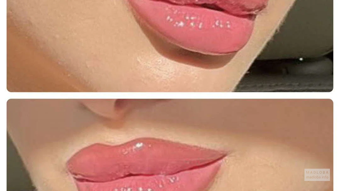 Дом красоты Glamour увеличение губ