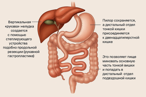 Билиопанкреатическое шунтирование.webp