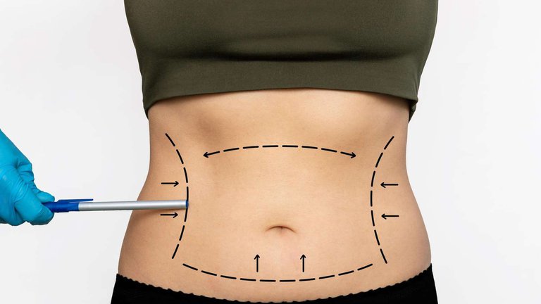 Fat removal in Batumi