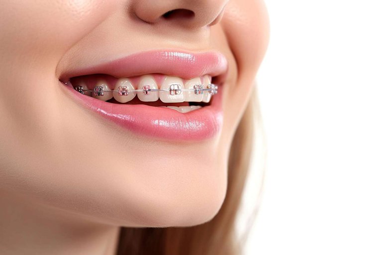 🏆 8 best clinics in Batumi for braces installation 2025: TOP dental clinics for a straight smile