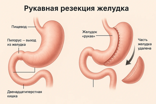 рукавная резекция желудка.webp